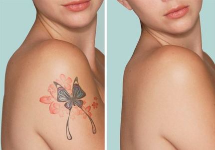 Laser Tattoo Removal