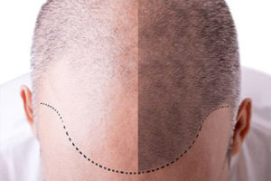 hair-transplantation-on-page