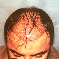 during hair transplantaion