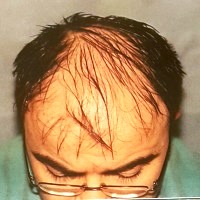 hair transplantaion before